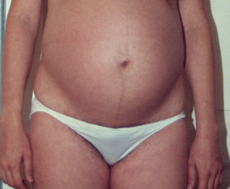 I slutninen af graviditeten bliver linie albae tydligere. Det skyldes at mavemusklerne går lidt fra hinanden pga. af at maven vokser.